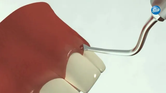 komet-dental-ceradrill-video-kronenverl-ngerung-schallspitzen image 1