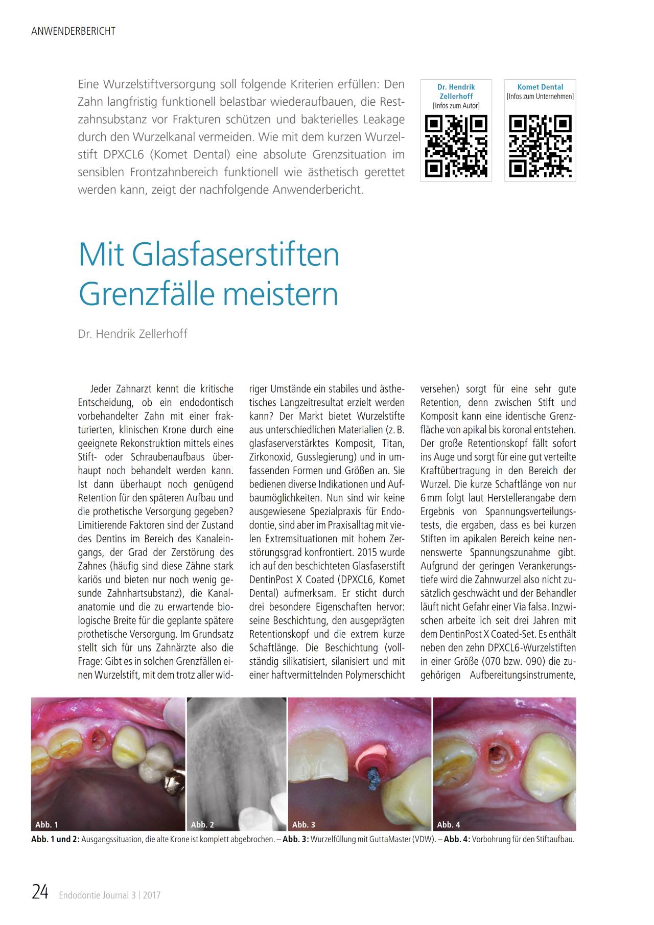 komet-dental-cerapost-fachbericht-glasfaserstifte image 1