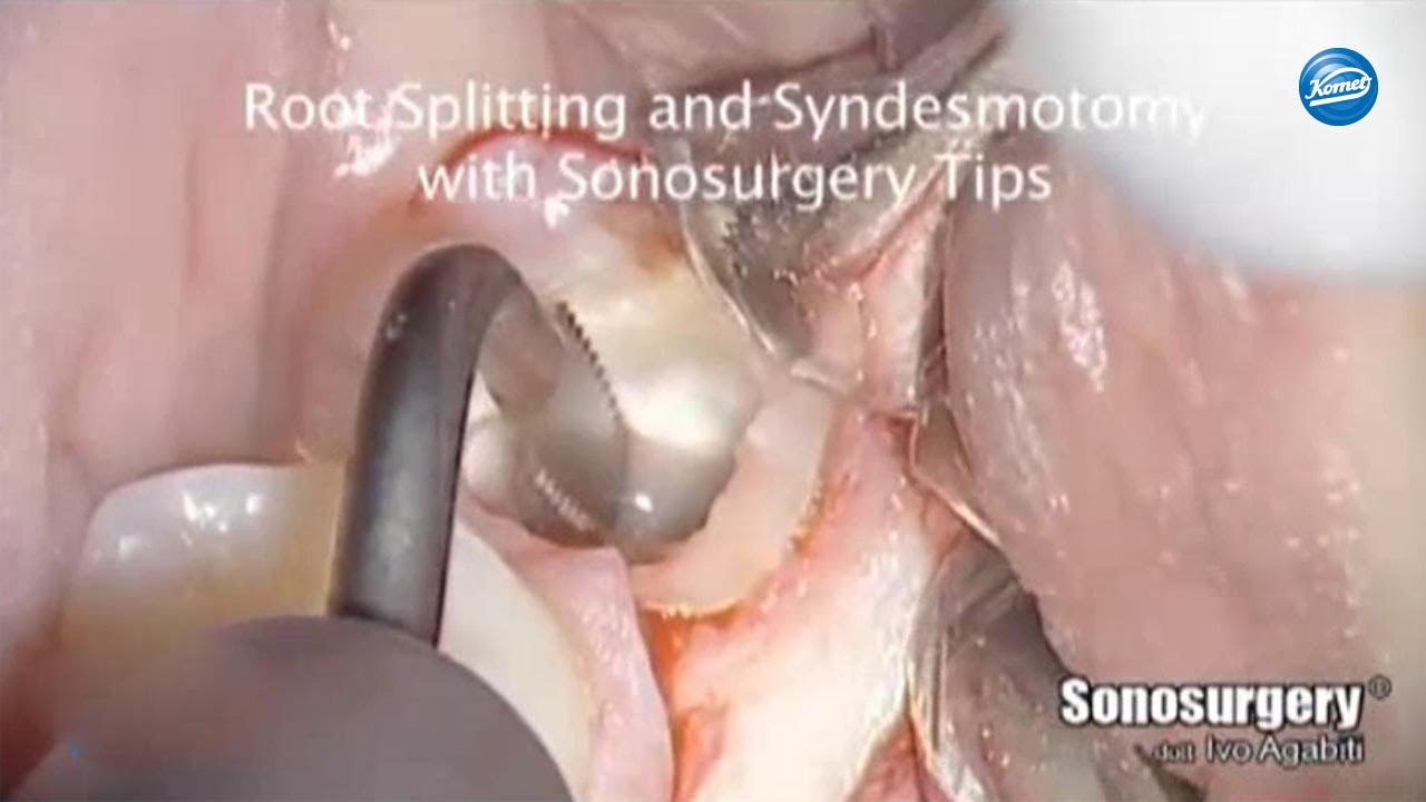 komet-dental-diao-video-weisheitszahn-extraktion-agabiti image 1