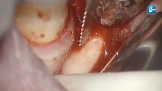 komet-diao-video-knochenblock-entnahme-intraoral image 1
