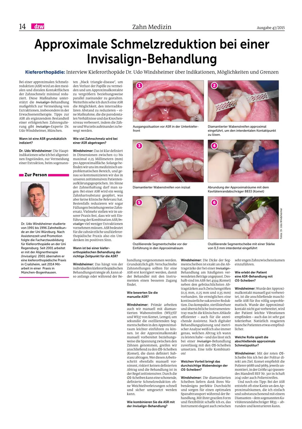 komet-dental-diao-approximale-schmelzreduktion-fachbericht-invisalign image 1