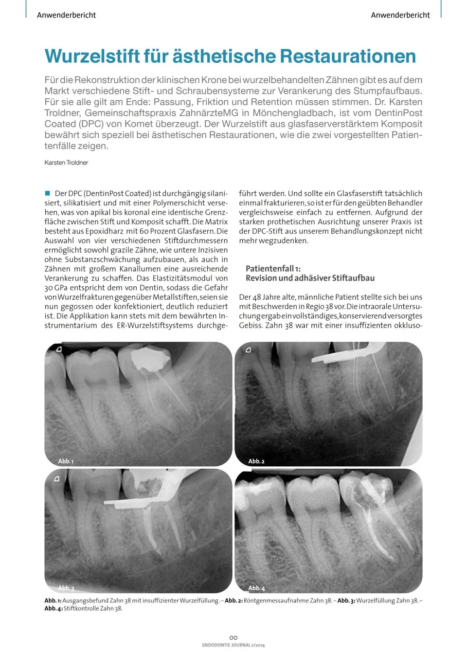komet-dental-cerapost-fachbericht-wurzelstift-sthetik image 1