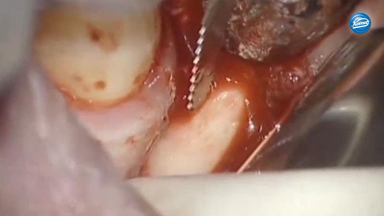 komet-ceradrill-video-intraorale-knochenbl-cke-schallspitzen image 1
