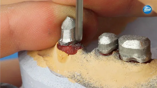 komet-dental-diao-video-italienisch-teleskopkronen-nem image 1