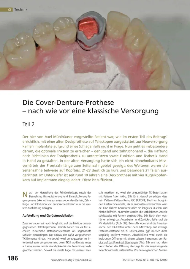 komet-dental-shax-cover-denture-prothese-fachbericht-teil-2 image 1