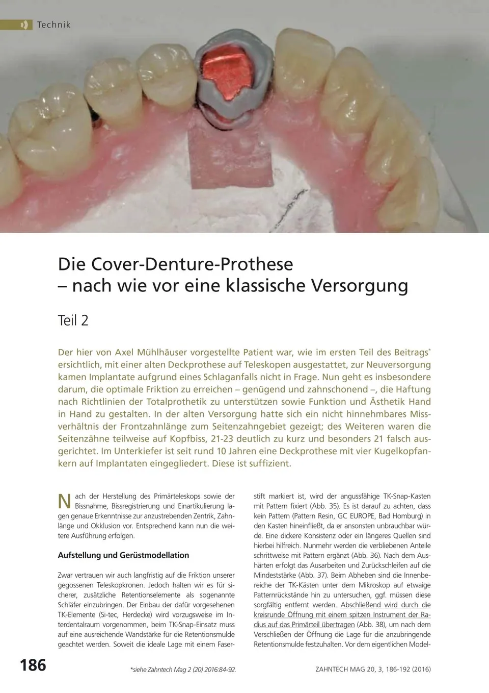 komet-dental-shax-cover-denture-prothese-fachbericht-teil-2 image 1