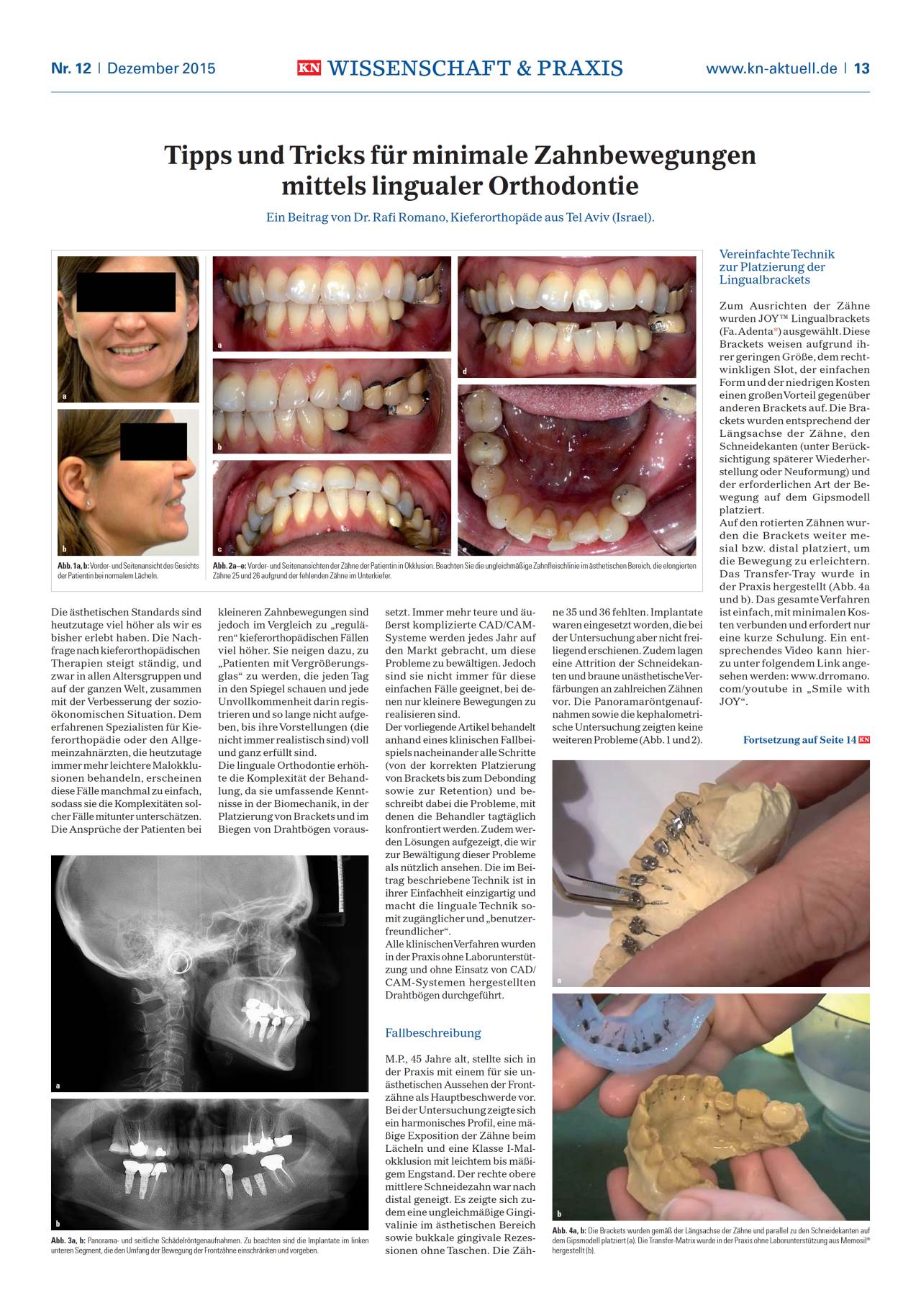 komet-dental-sonicline-linguale-orthodontie-minimale-bewegung image 1