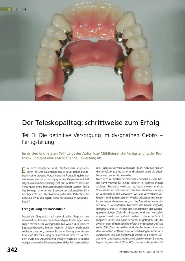 komet-dental-diao-teleskopalltag-fachbericht-m-hlhauser-zahntechnik image 1