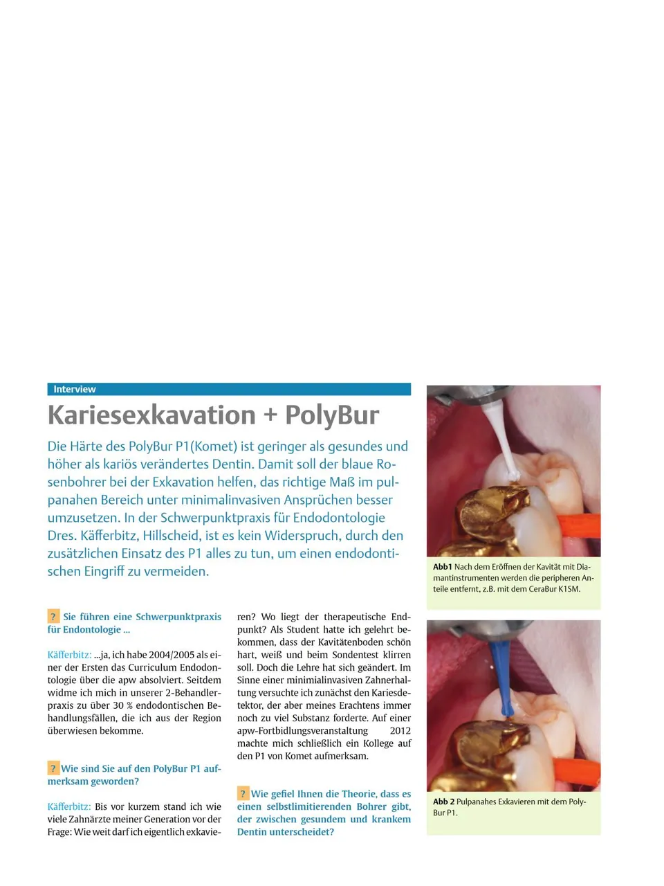 komet-polybur-p1-fachbericht-kariesexkavation-dentin image 1