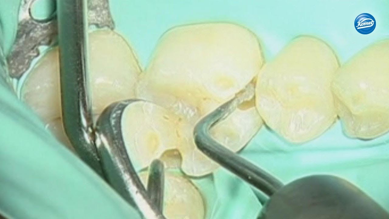 komet-sonicline-cavity-preparation-video-dr-agabiti image 1