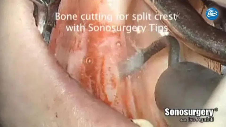 komet-dental-ceradrill-split-crest-video-dr-agabiti-implantologie image 1