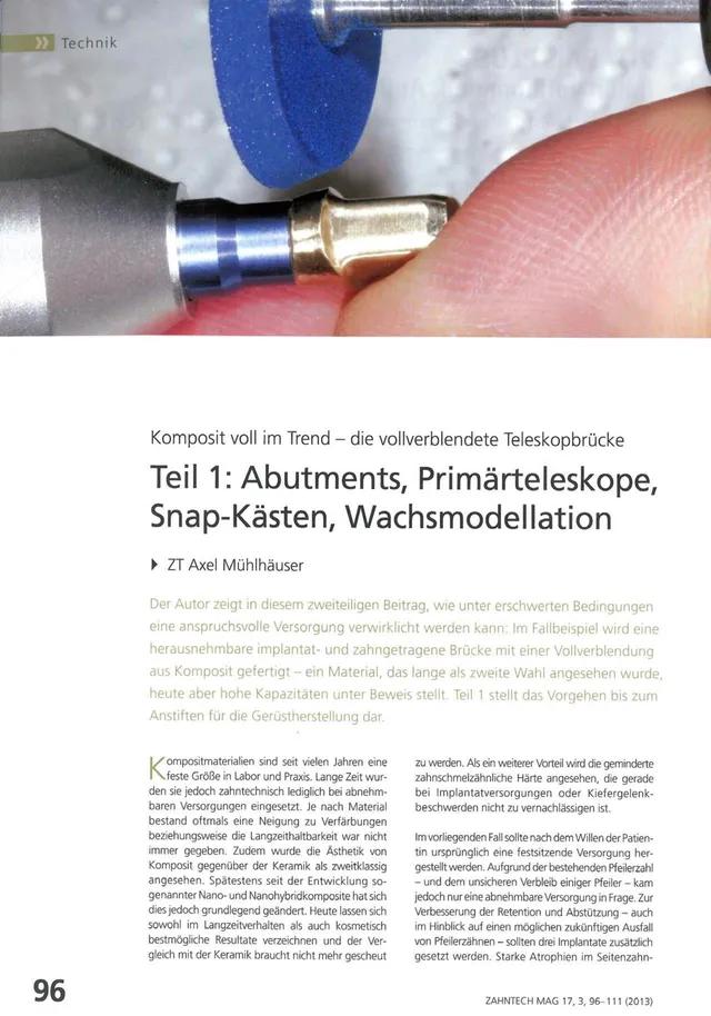 komet-dental-ceracut-teleskopbr-cke-komposit-fachbericht image 1