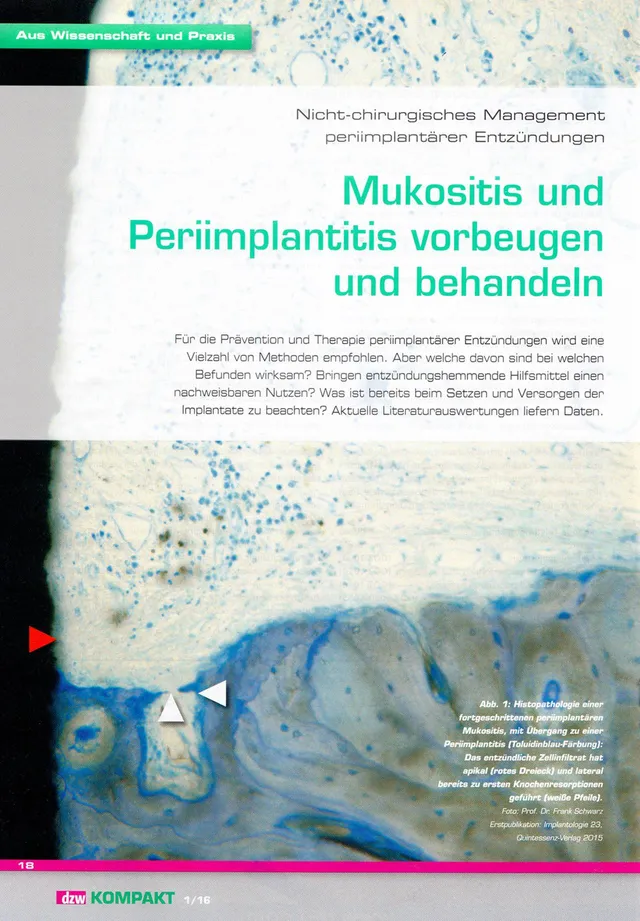 komet-dental-ceradrill-fachbericht-mukositis-periimplantitis-dzw-03-2016 image 1