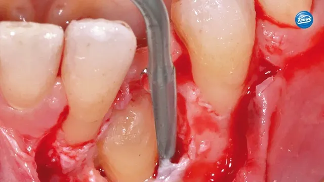 komet-dental-sonicline-video-weisheitszahn-sfs90m-sfs90d image 1