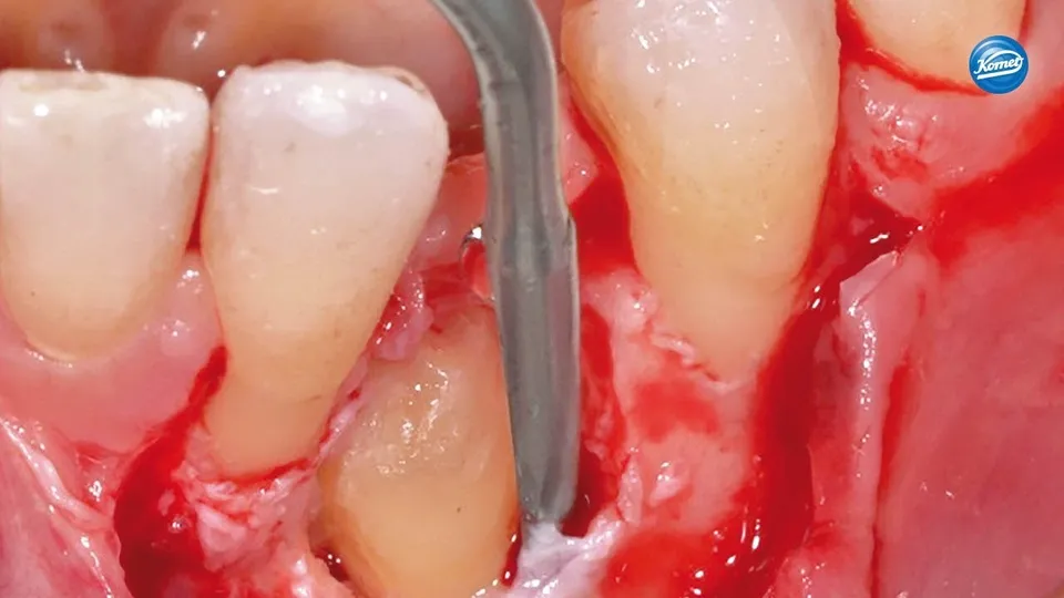 komet-dental-sonicline-video-weisheitszahn-sfs90m-sfs90d image 1