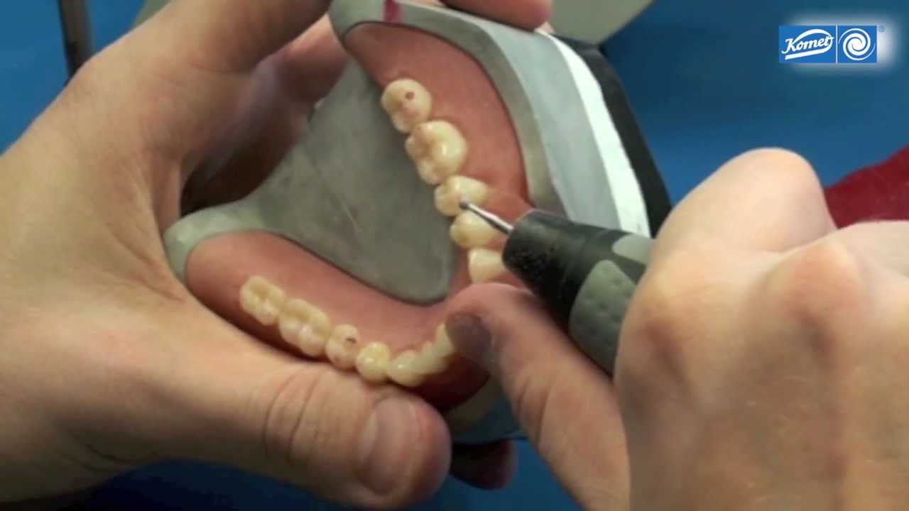 komet-shax-video-kunststoff-prothese-ausarbeitung image 1