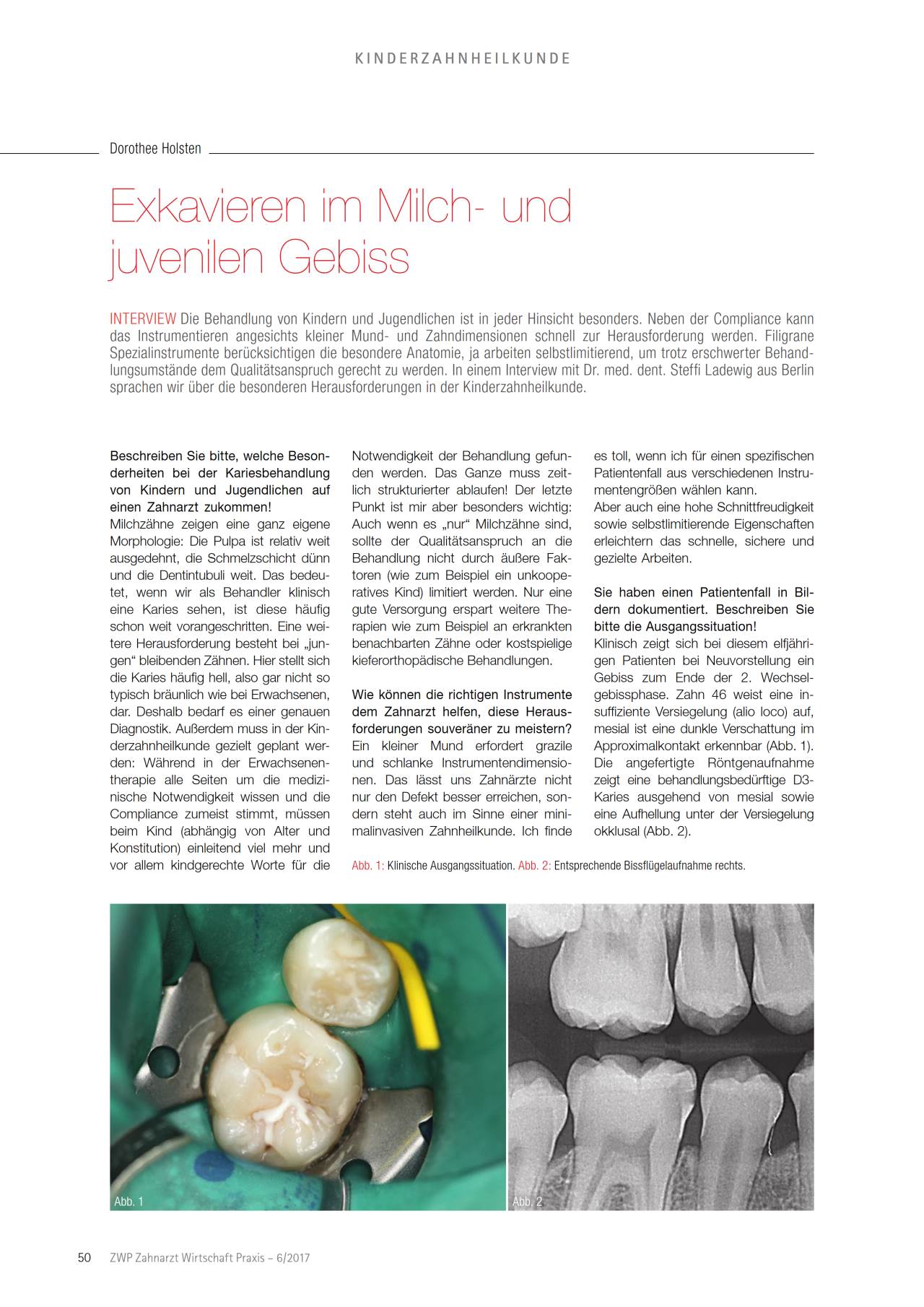 komet-dental-diao-fachbericht-exkavieren-milchgebiss image 1