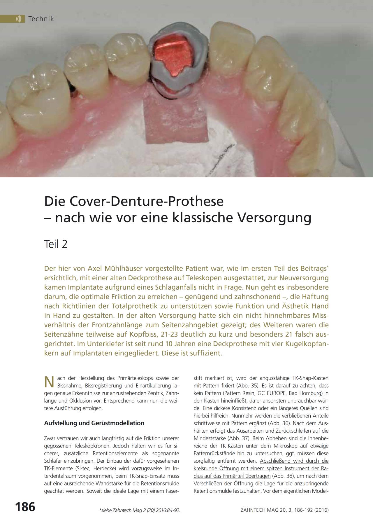 komet-dental-shax-cover-denture-prothese-fachbericht-teil-2 image 1