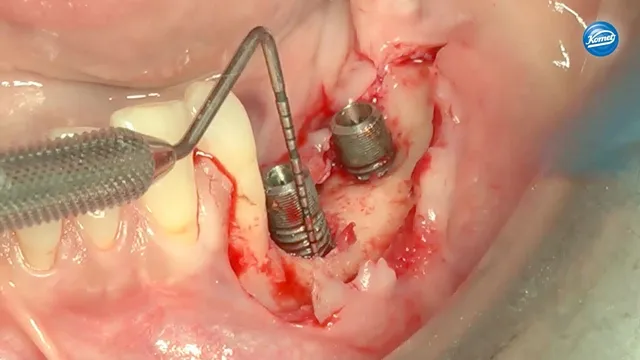 komet-dental-ceradrill-periimplantitis-behandlung-video image 1
