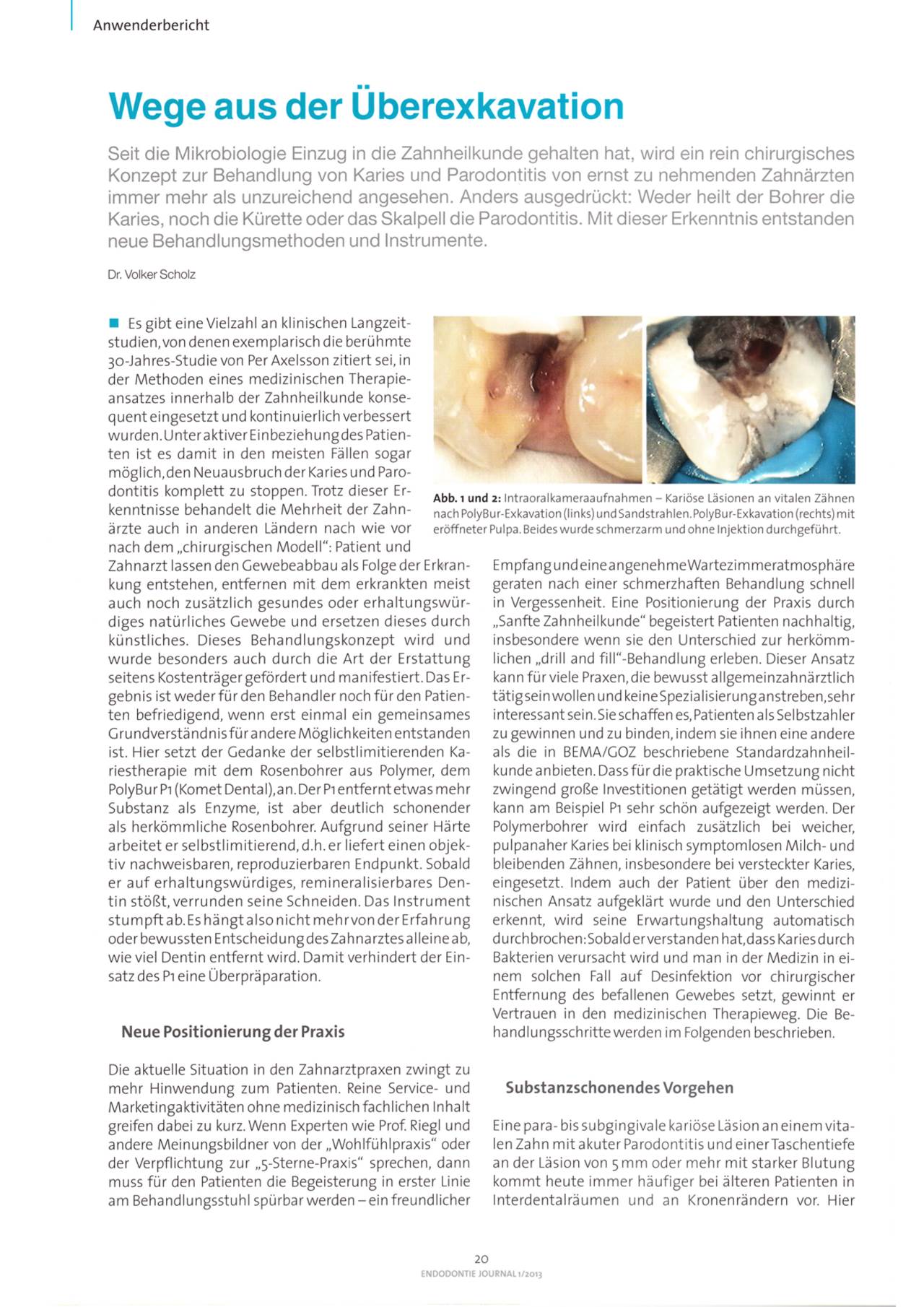 komet-dental-diao-wege-aus-der-berexkavation-fachbericht-karies image 1