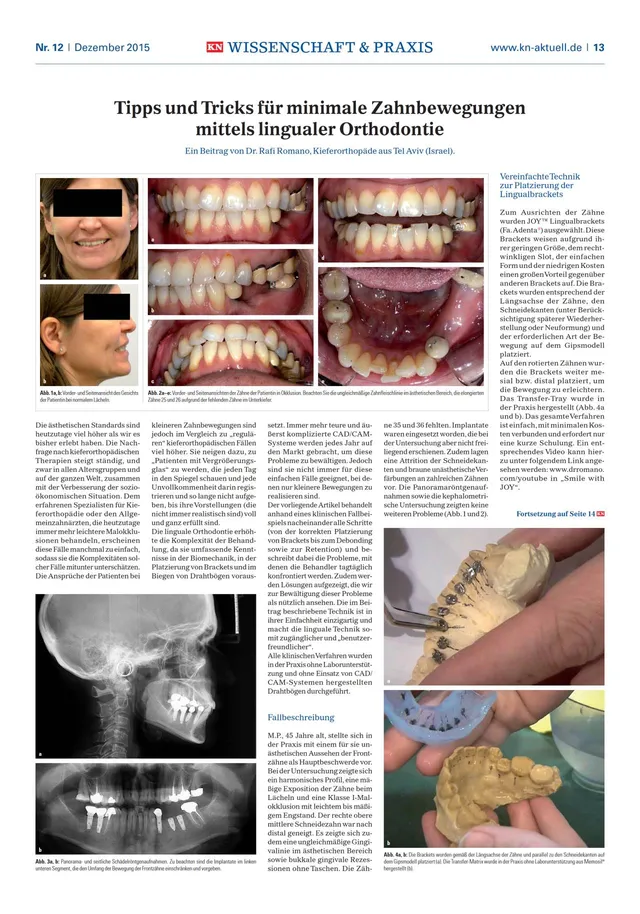 komet-dental-sonicline-linguale-orthodontie-minimale-bewegung image 1
