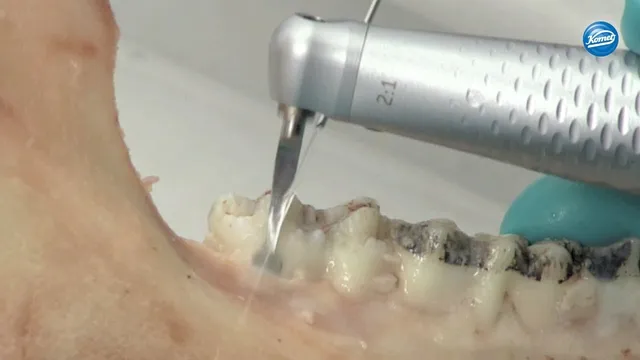 komet-dental-fq-video-hubfeilen-diamantiert-parodontal image 1