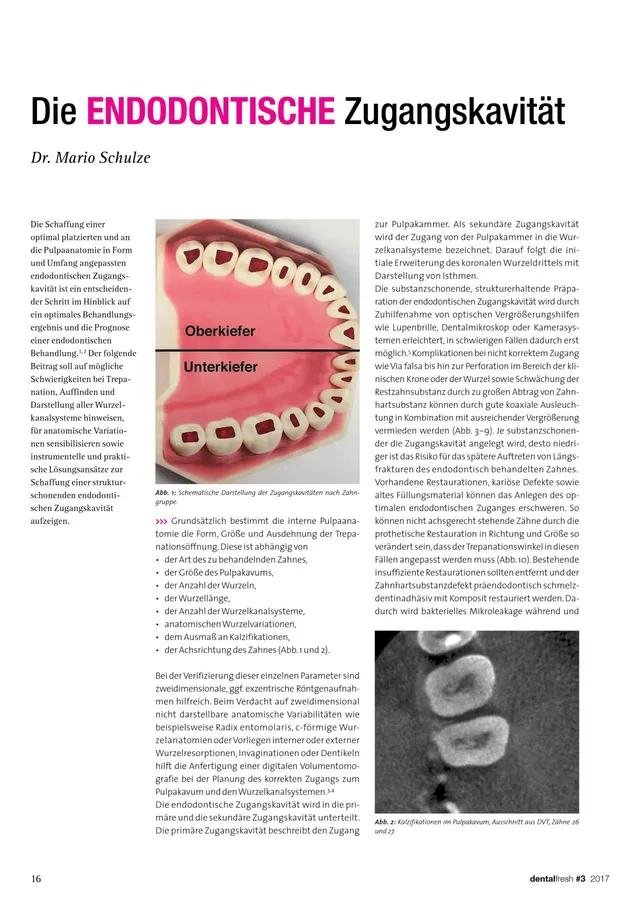 komet-dental-fq-fachbericht-zugangskavit-t-endodontie image 1