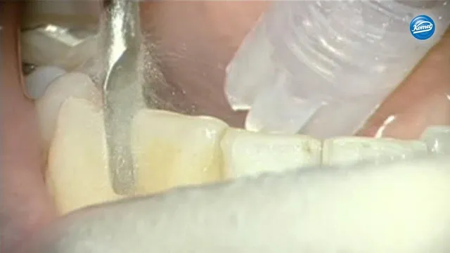 komet-diao-video-proximale-schmelzreduktion-kieferorthop-die image 1
