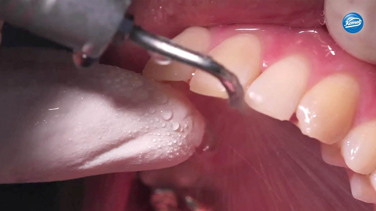 komet-sonicline-video-sonostripping-stripping image 1