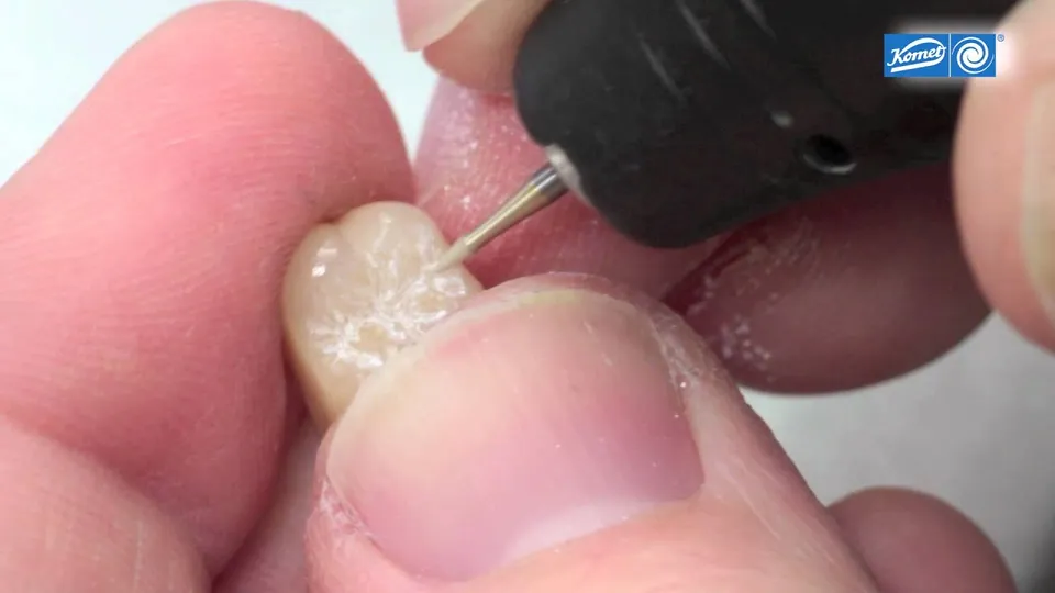 komet-dental-diao-video-okklusion-seitenzahnkrone-keramik image 1