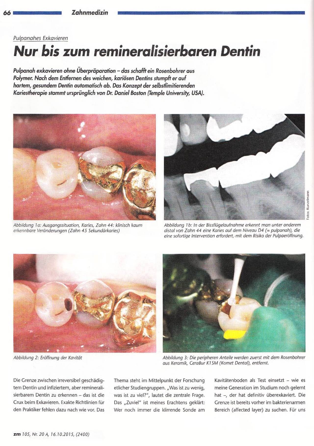 komet-diao-fachbericht-exkavieren-dentin-zahnerhalt image 1