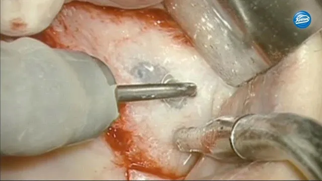 komet-dental-sonicline-video-open-sinus-lift-sonic-tips-agabiti image 1