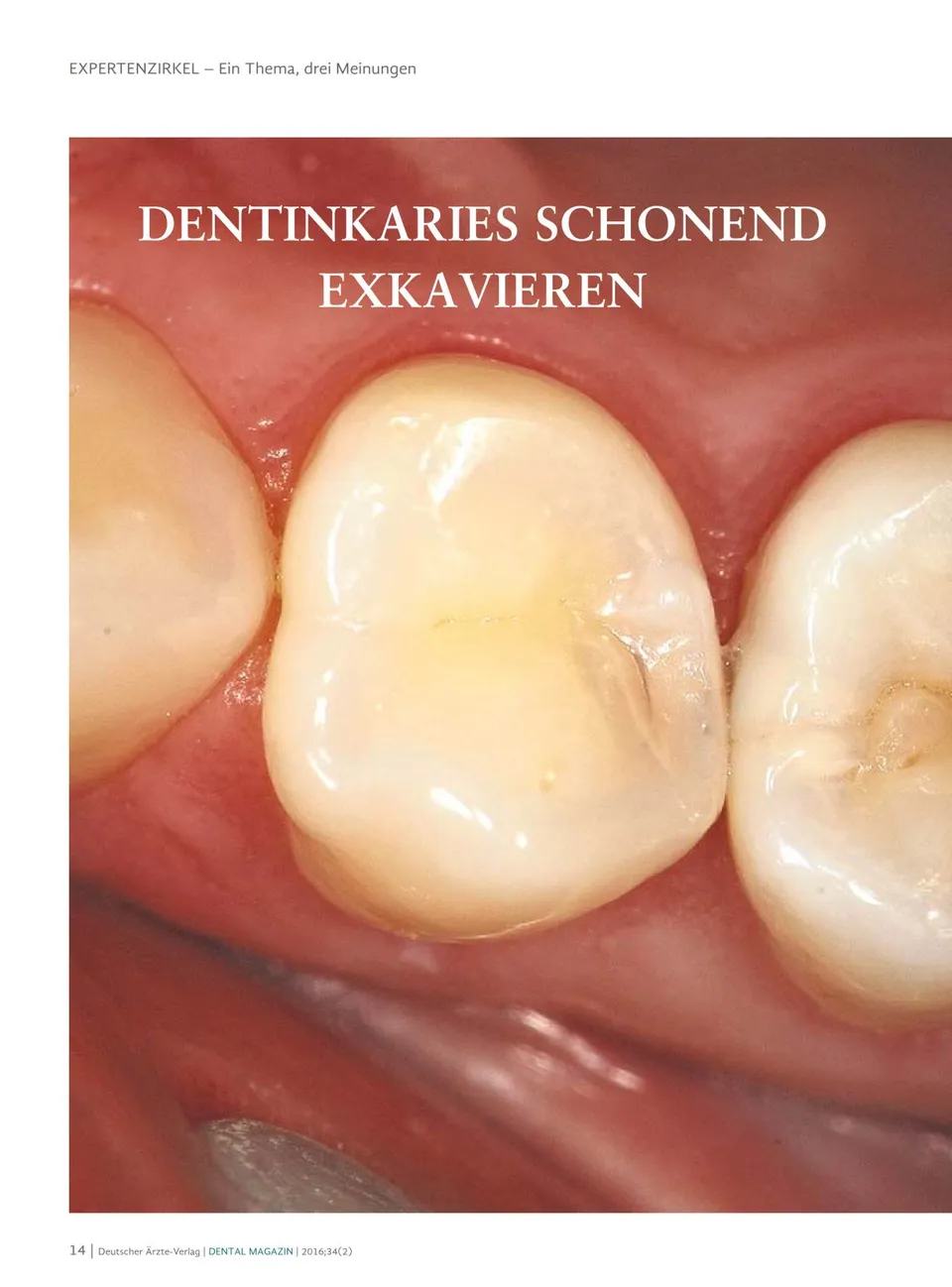 komet-diao-dentinkaries-fachbericht-schonend-exkavieren image 1