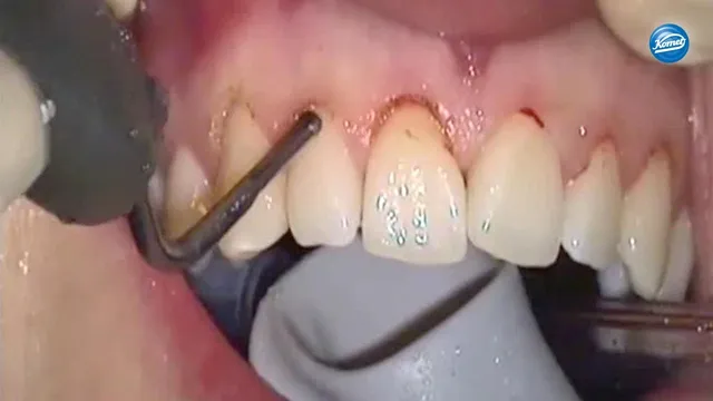 komet-diao-video-chirurgische-kronenverl-ngerung-sonic-tips image 1