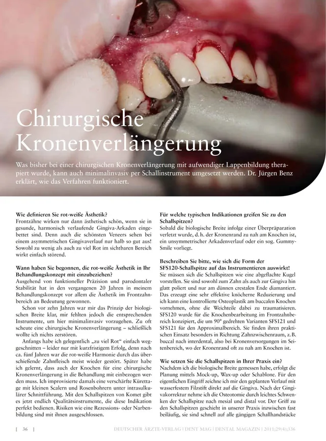 komet-dental-ceradrill-fachbericht-kronenverl-ngerung-chirurgie image 1