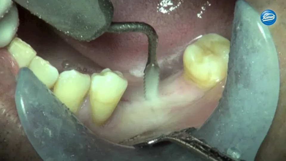 komet-ceradrill-video-split-crest-sonosurgery-technik image 1