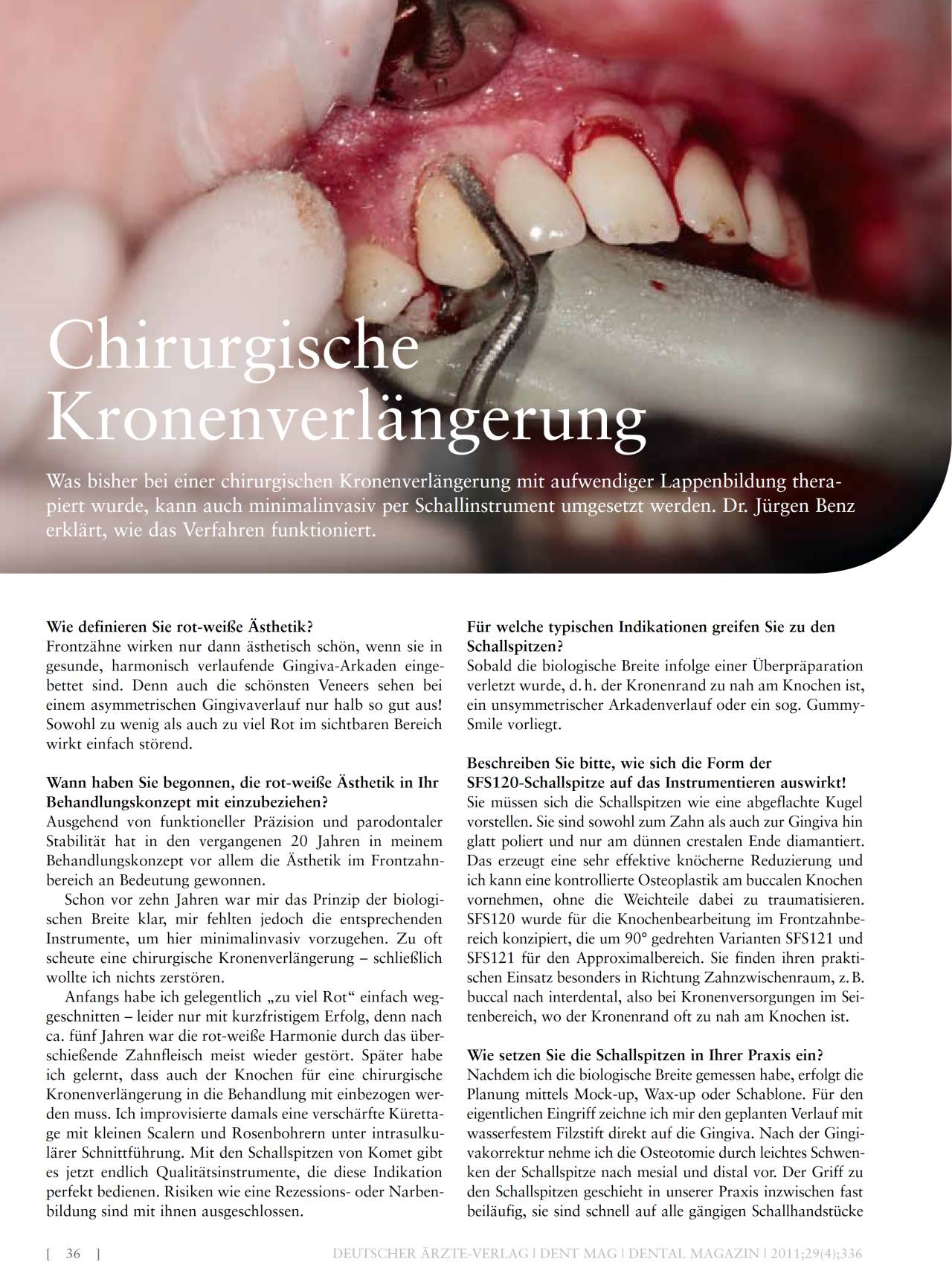 komet-dental-ceradrill-fachbericht-kronenverl-ngerung-chirurgie image 1