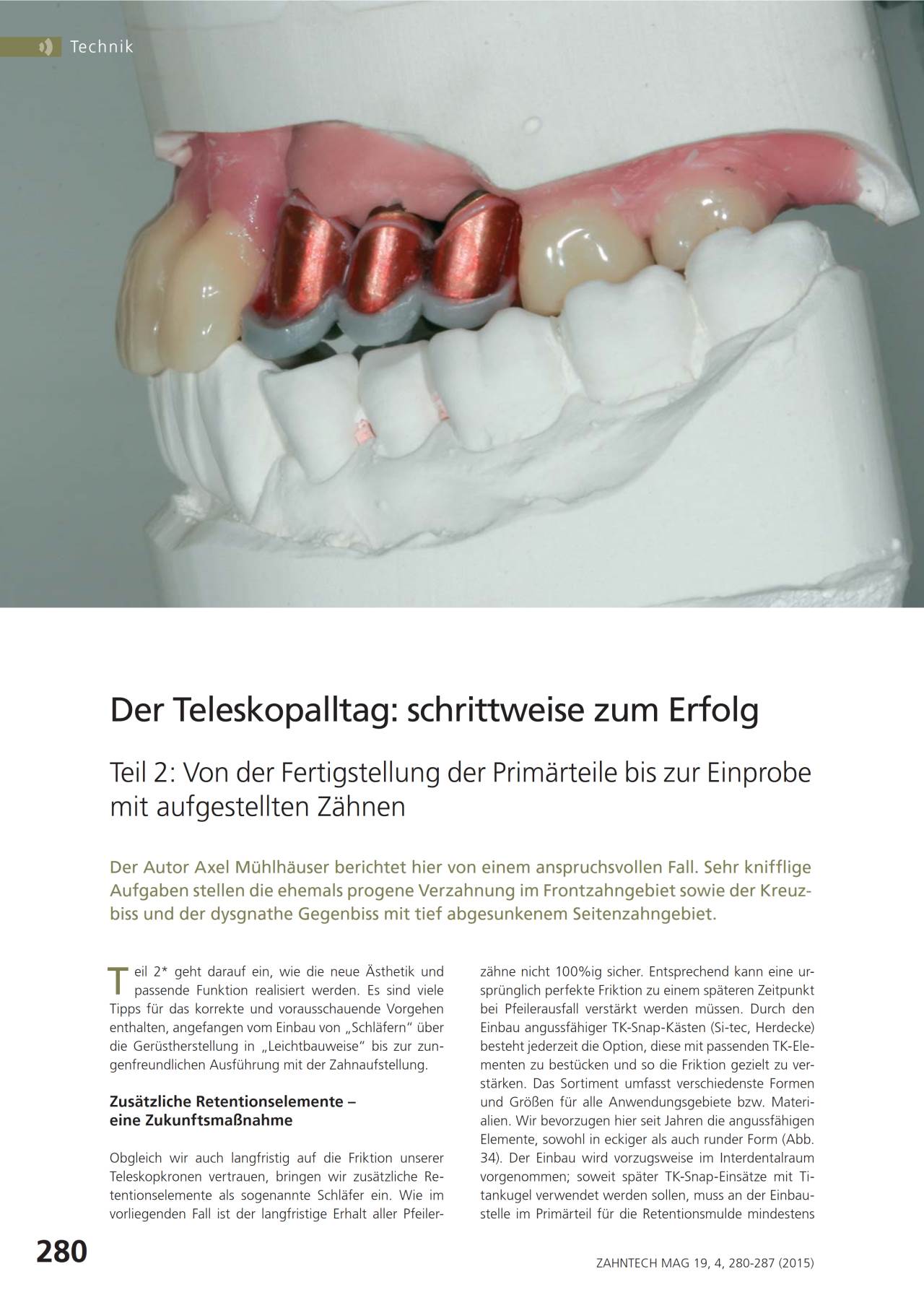 komet-dental-diao-der-teleskopalltag-fachbericht-prim-rteile-einprobe image 1