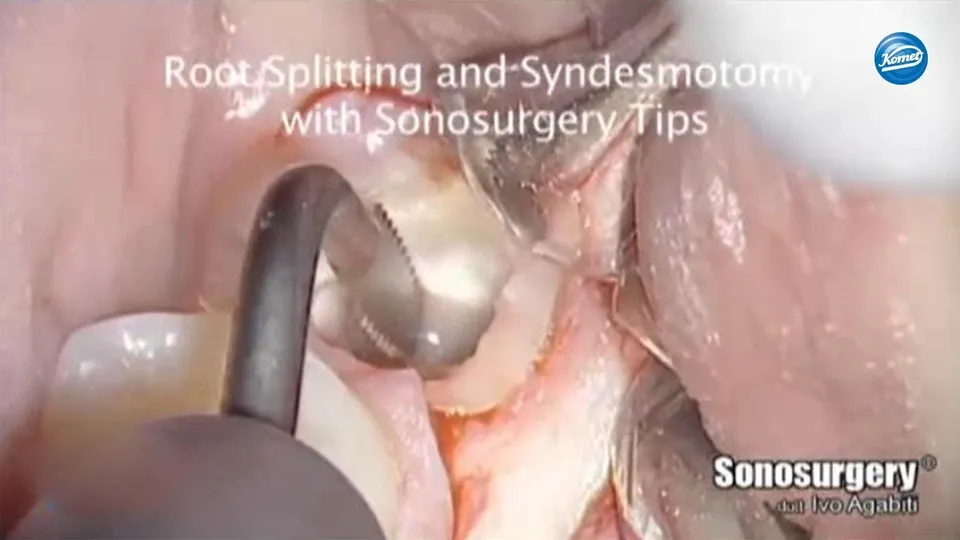 komet-dental-diao-video-weisheitszahn-entfernung-agabiti-2 image 1