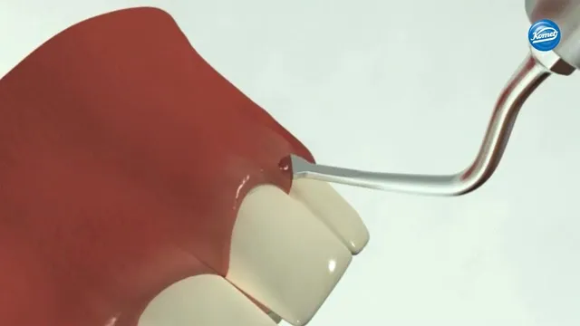 komet-dental-diao-kronenverlaengerung-video-schallspitzen image 1