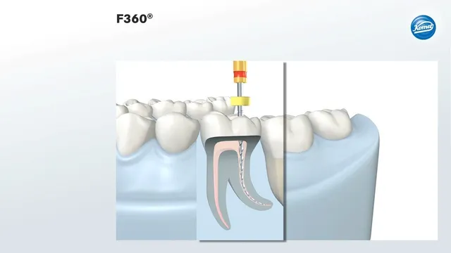komet-f360-animation-lehrvideo-wurzelkanalaufbereitung image 1