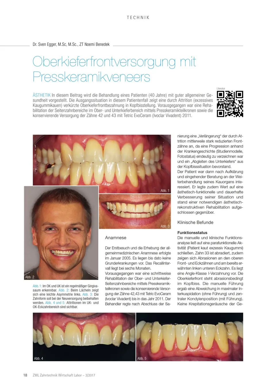 komet-ceracut-fachbericht-presskeramikveneers-front image 1