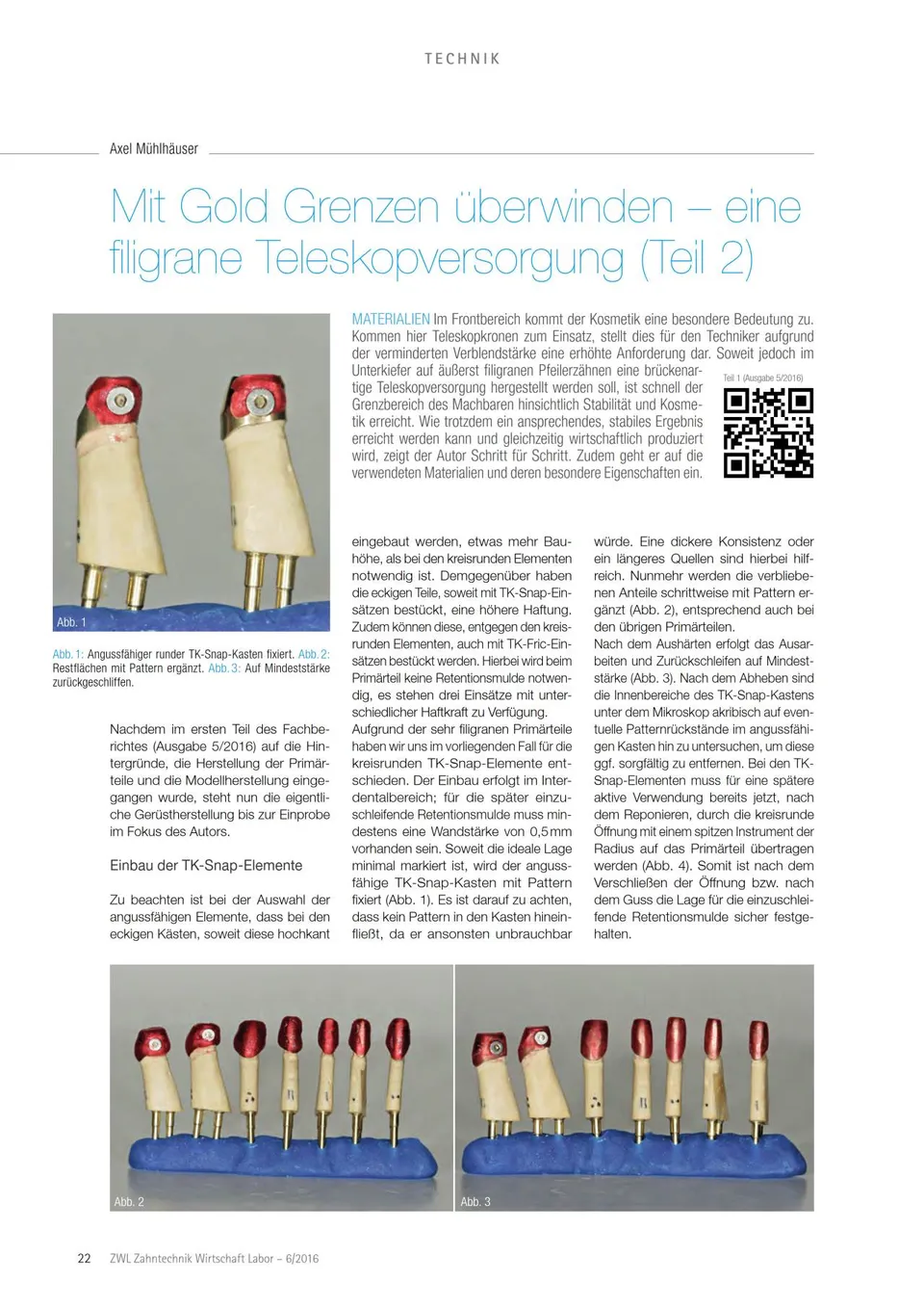 komet-dental-diao-fachbericht-teleskopversorgung-gold image 1
