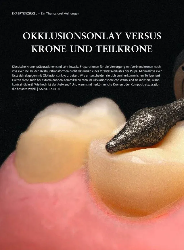 komet-dental-diao-okklusionsonlay-versus-krone-fachbericht-pdf image 1