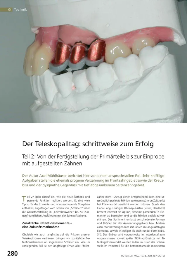 komet-dental-diao-der-teleskopalltag-fachbericht-prim-rteile-einprobe image 1