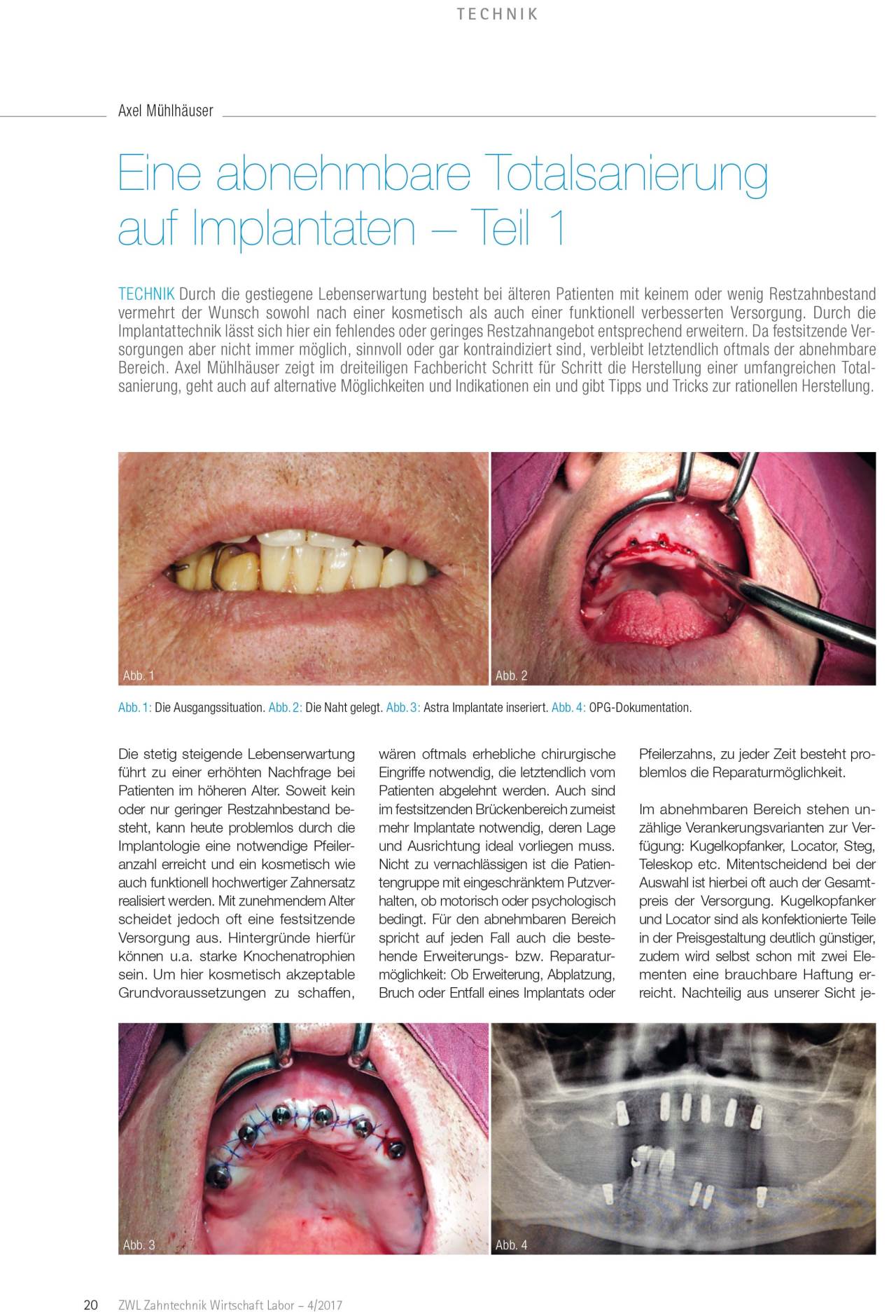 komet-dental-ceradrill-fachbeitrag-totalsanierung-implantat-teil-1 image 1