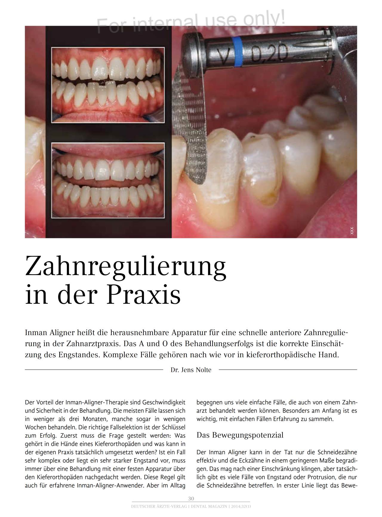 komet-dental-diao-fachbericht-zahnregulierung-inman-aligner image 1