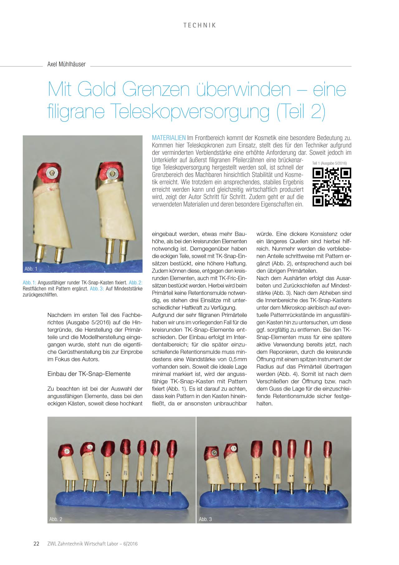komet-dental-diao-fachbericht-teleskopversorgung-gold image 1