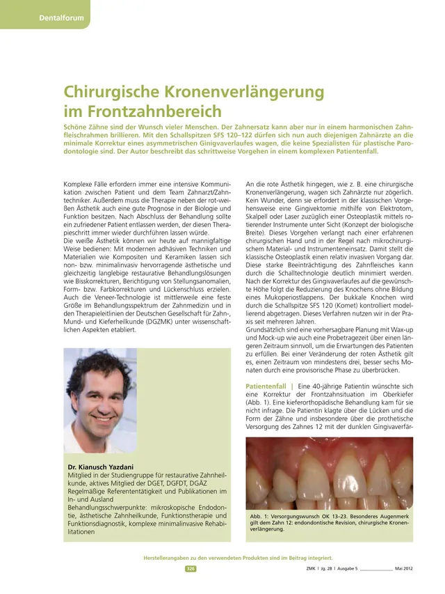 komet-ceradrill-fachbericht-kronenverl-ngerung-frontzahn-2012 image 1