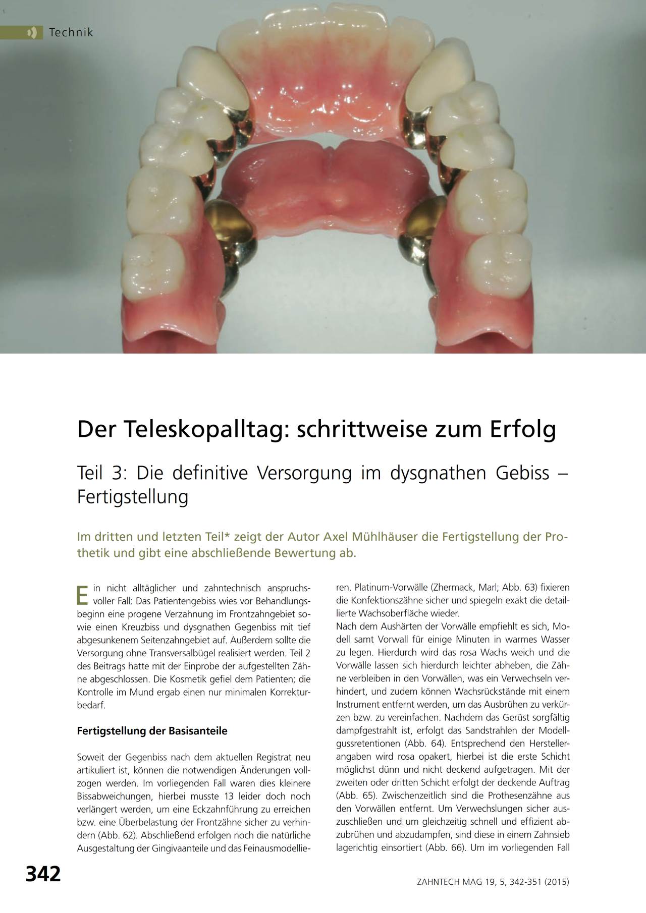 komet-dental-diao-teleskopalltag-fachbericht-m-hlhauser-zahntechnik image 1